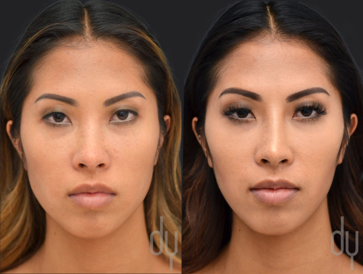 NONSURGICAL :: BOTOX<br>V-line Masseter Reduction