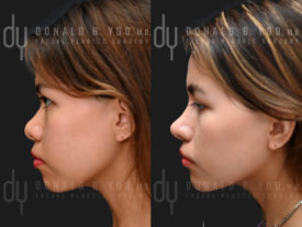 SURGICAL :: RHINOPLASTY<br>Rhinoplasty and Chin Augmentation