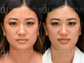 NONSURGICAL :: BOTOX<br>V-line Masseter Reduction