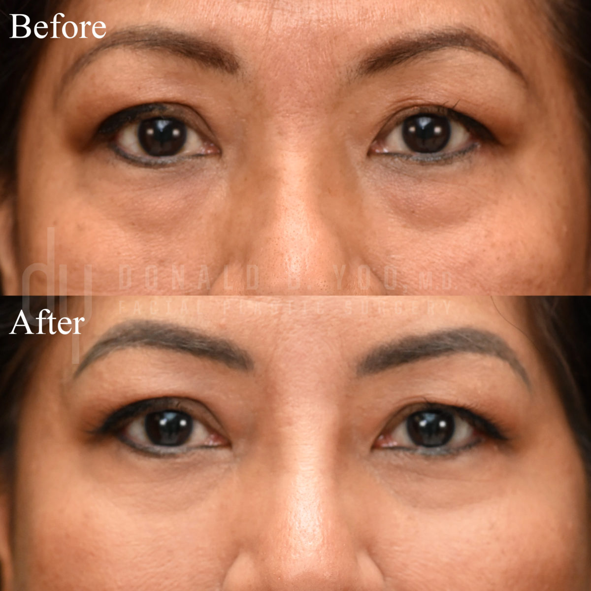 SURGICAL :: BLEPHAROPLASTY<br>Lower Blepharoplasty with Fat Repositioning