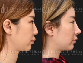 SURGICAL :: RHINOPLASTY<br>Rhinoplasty and Chin Augmentation