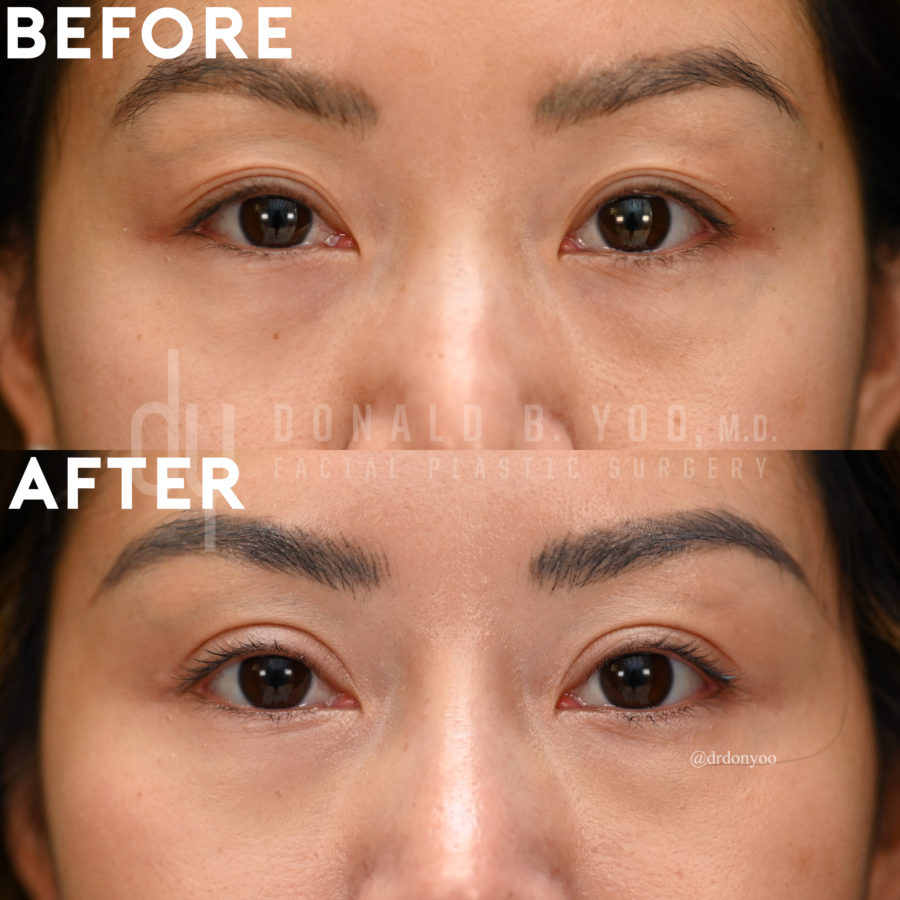 SURGICAL :: BLEPHAROPLASTY<br>Upper Blepharoplasty