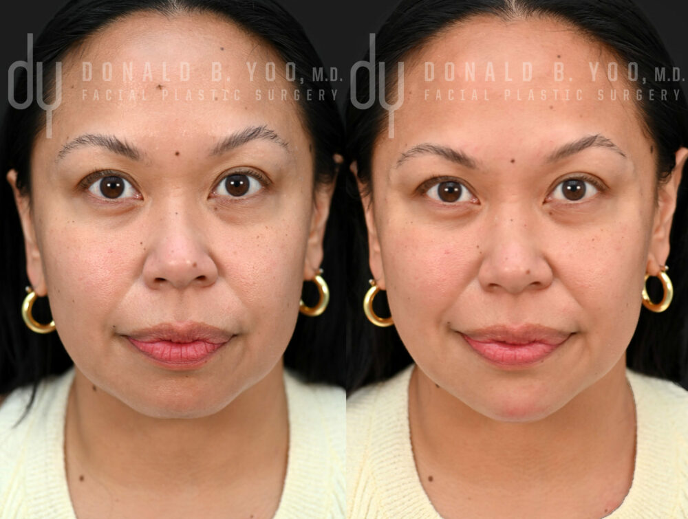 NONSURGICAL :: FILLERS <br> Nonsurgical Chin augmentation