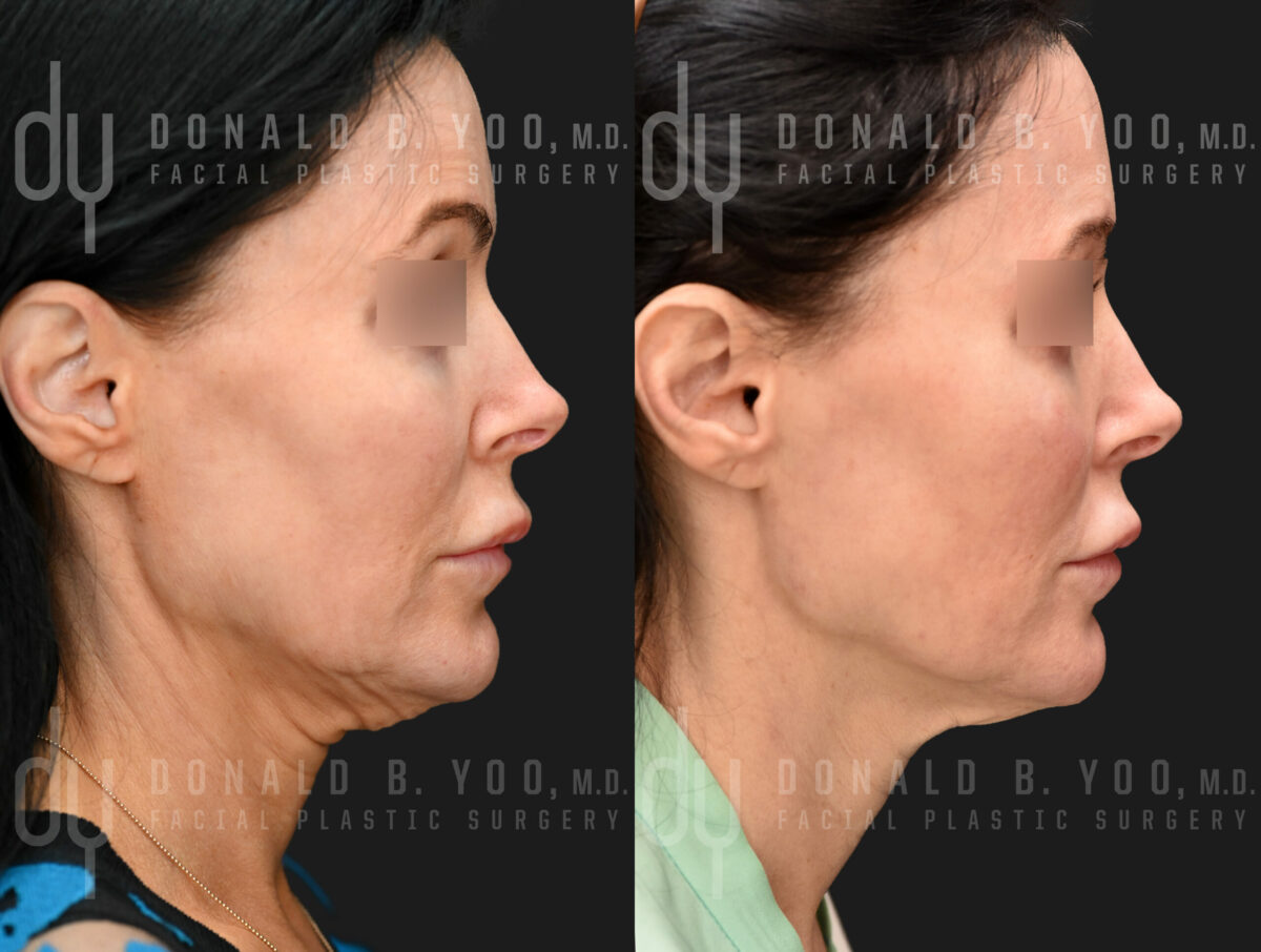 NONSURGICAL :: POTENZA<br> Potenza for face tightening