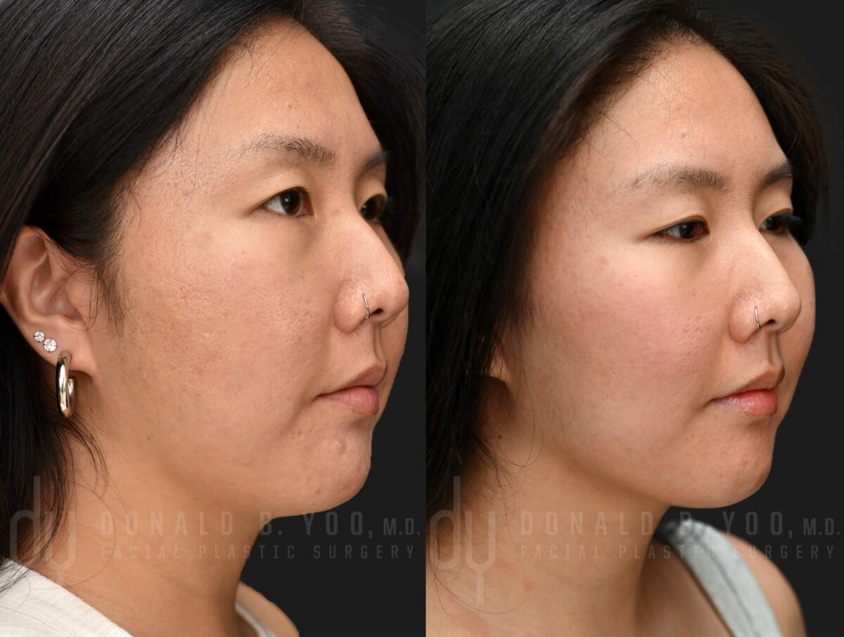 NONSURGICAL :: POTENZA<br> Potenza for face tightening