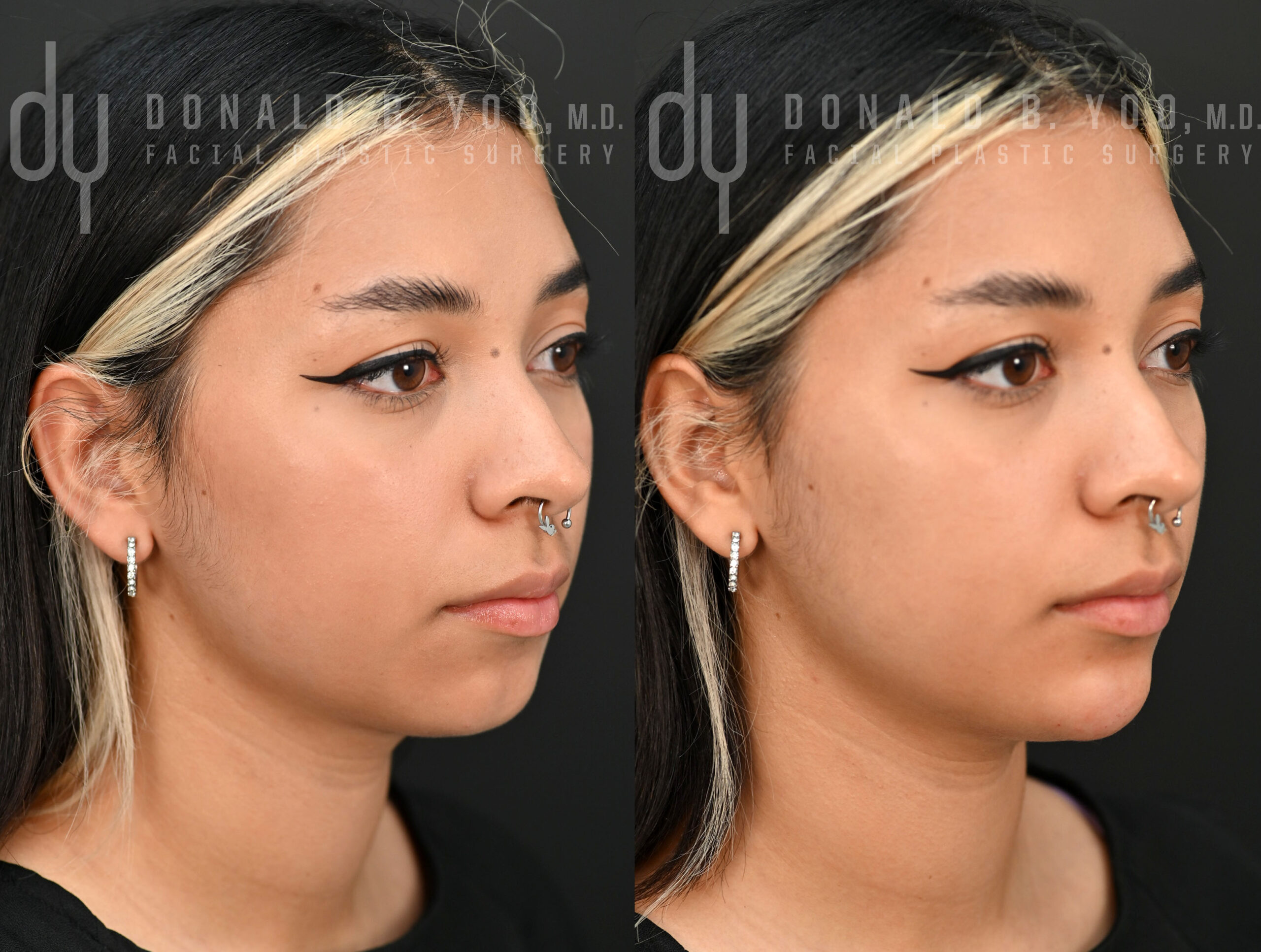NONSURGICAL :: FILLERS <br> Chin filler