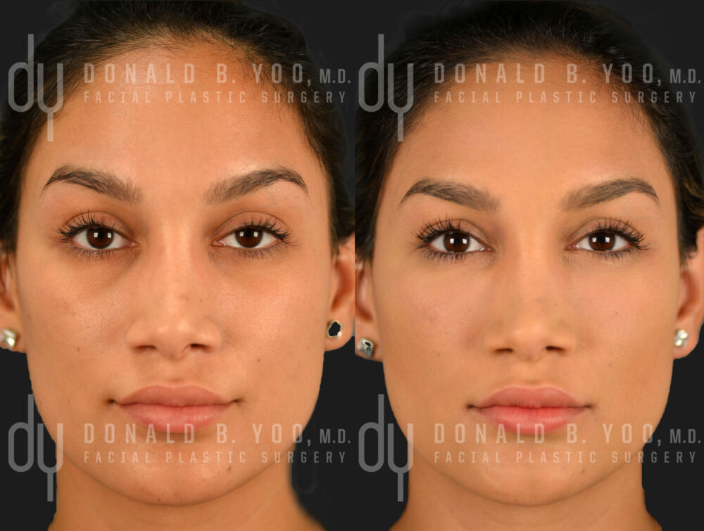 NONSURGICAL :: FILLERS <br> Tear Trough Under Eye Filler