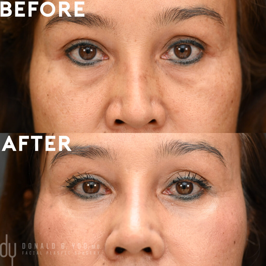 Lower blepharoplasty with fat repositioning to eliminate undereye bags.
