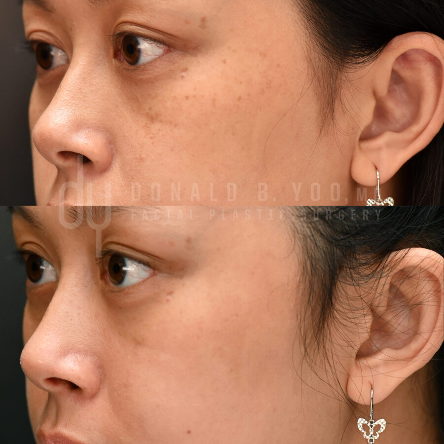 NONSURGICAL :: PICOSURE<br>Picosure for sun spots and aging spots