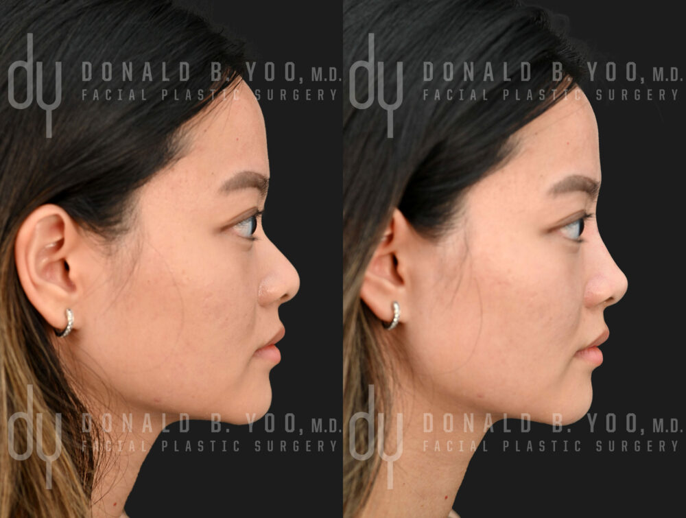 NONSURGICAL :: FILLERS<br>Nonsurgical Rhinoplasty