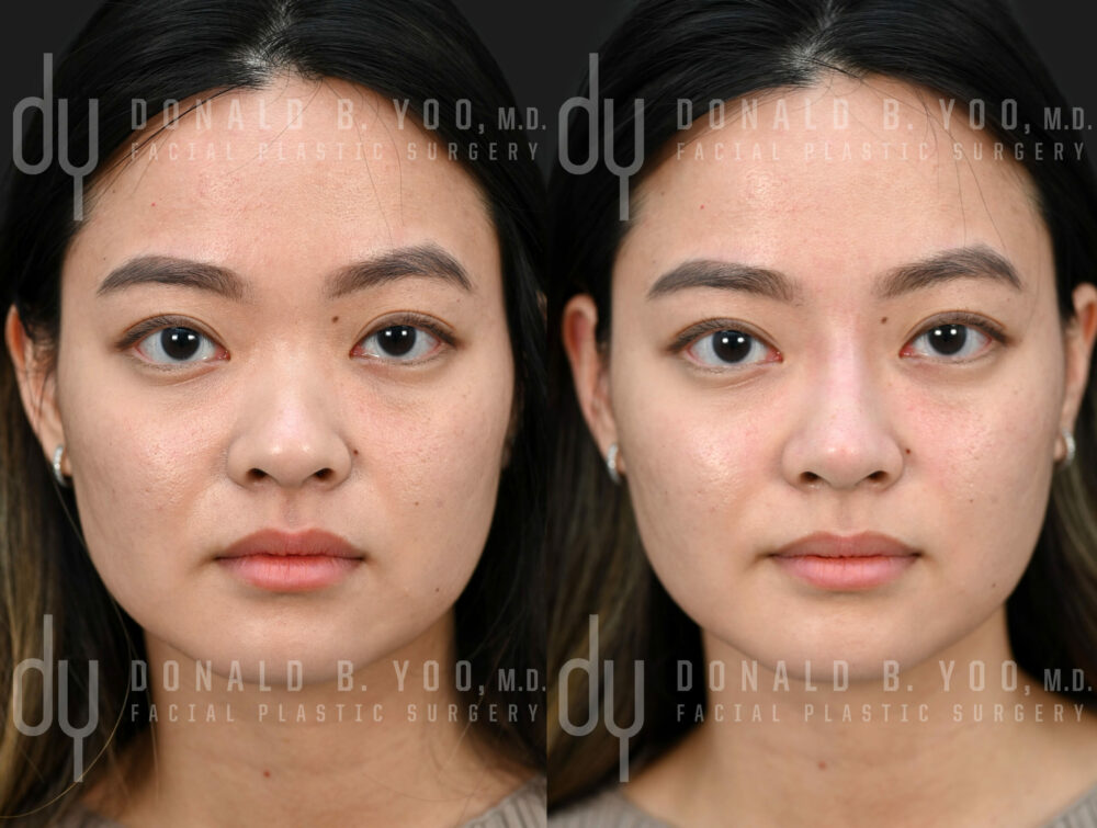 NONSURGICAL :: FILLERS <br> Nonsurgical Rhinoplasty 