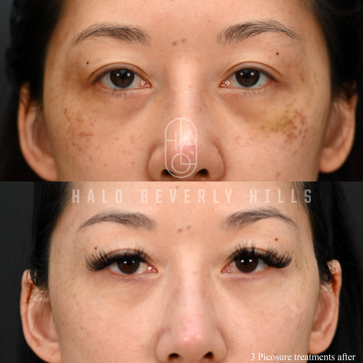 NONSURGICAL :: PICOSURE<br>Picosure for sun spots and aging spots