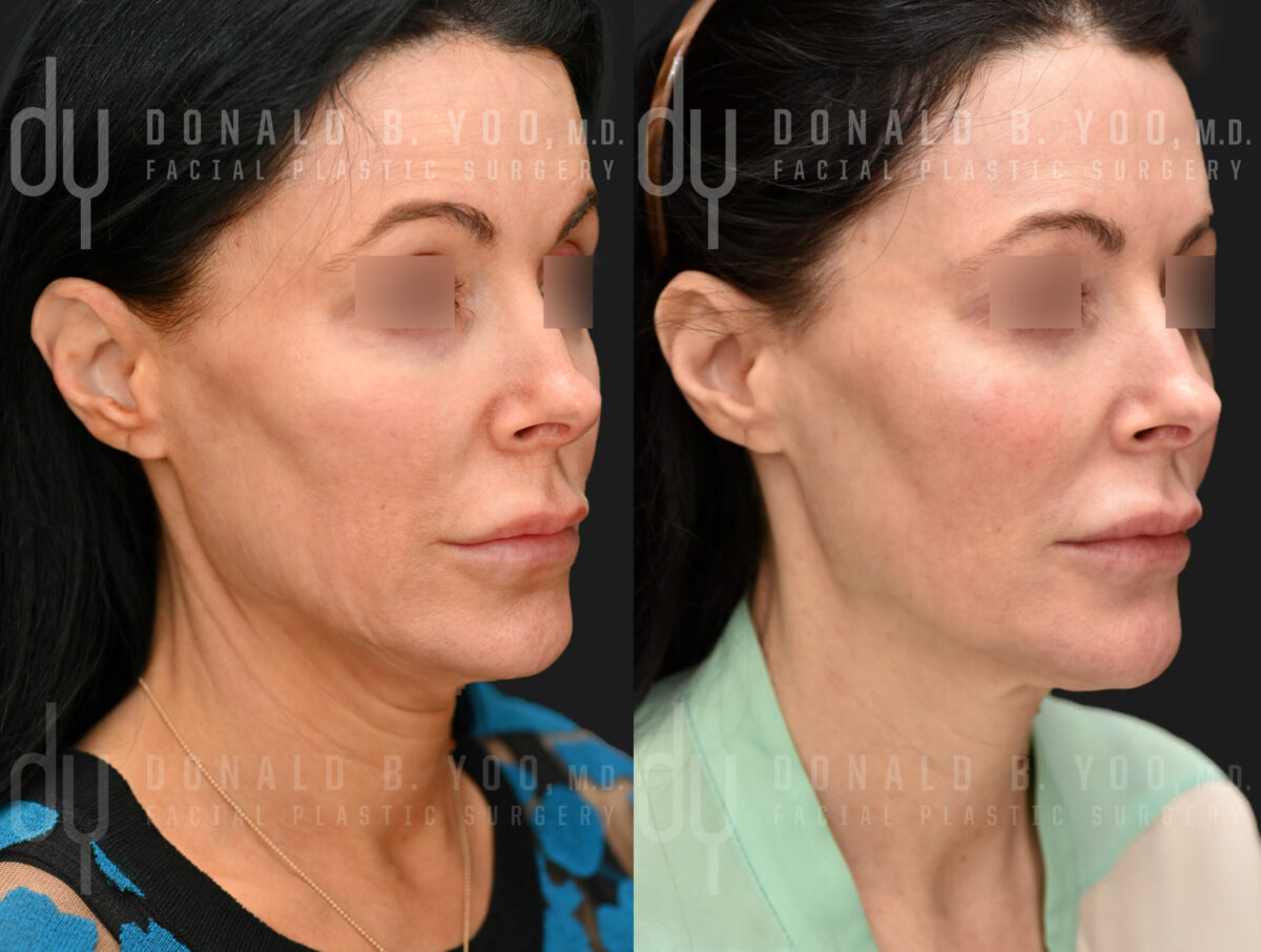 NONSURGICAL :: POTENZA<br> Potenza for face tightening
