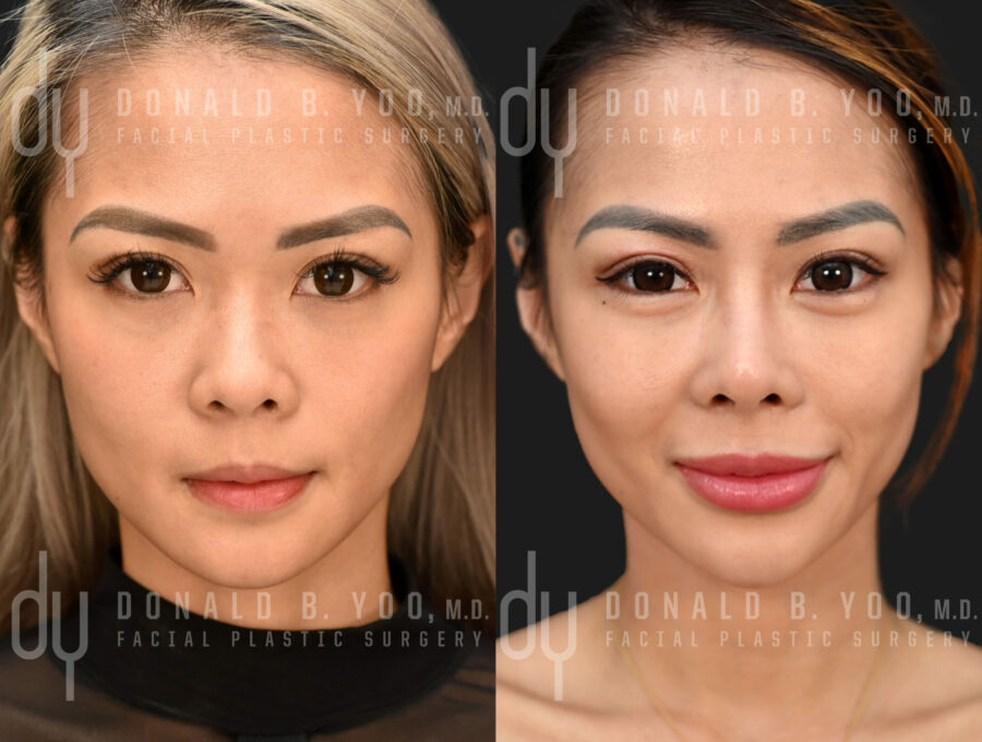 SURGICAL :: RHINOPLASTY<br>Asian Rhinoplasty