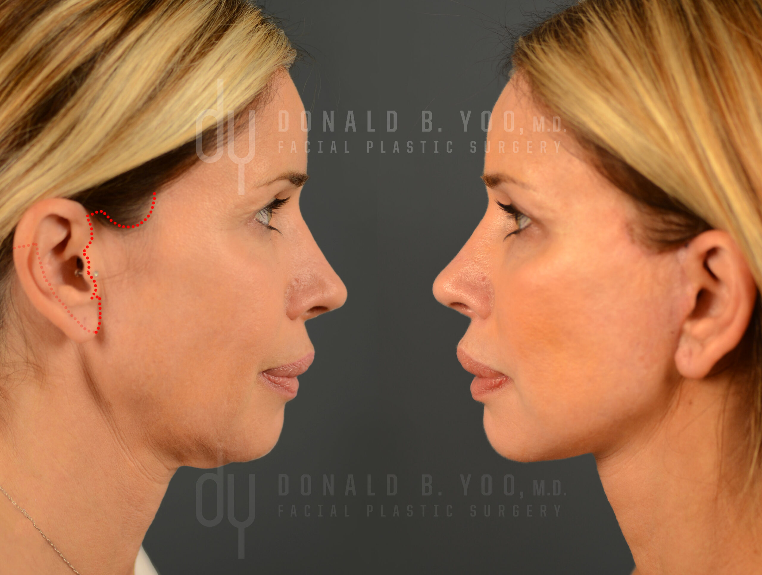 What is The Natural Facelift?, Blog