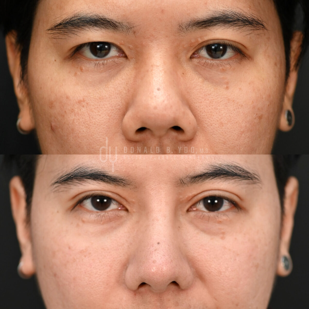 SURGICAL :: BLEPHAROPLASTY<br>Upper Blepharoplasty