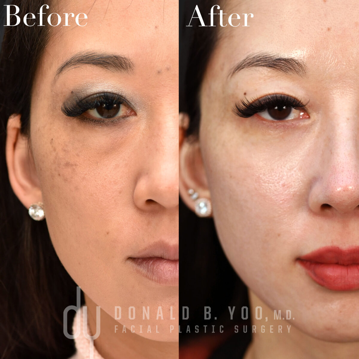 SURGICAL :: BLEPHAROPLASTY<br>Lower Blepharoplasty with Fat Repositioning