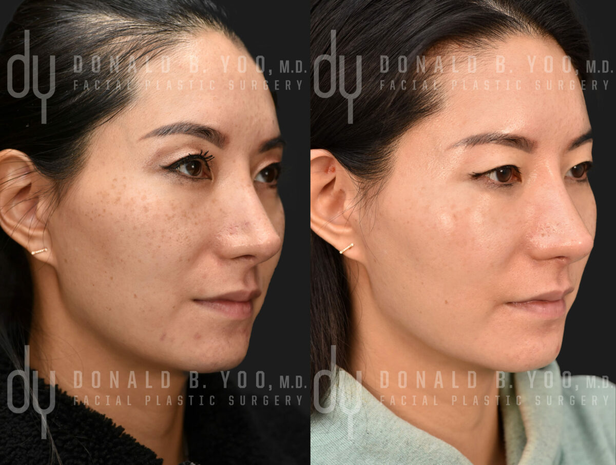 NONSURGICAL :: PICOSURE<br>Picosure for acne scars and hyper pigmentation