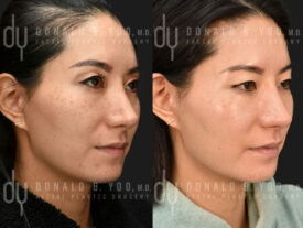 NONSURGICAL :: PICOSURE<br>Picosure for acne scars and hyper pigmentation