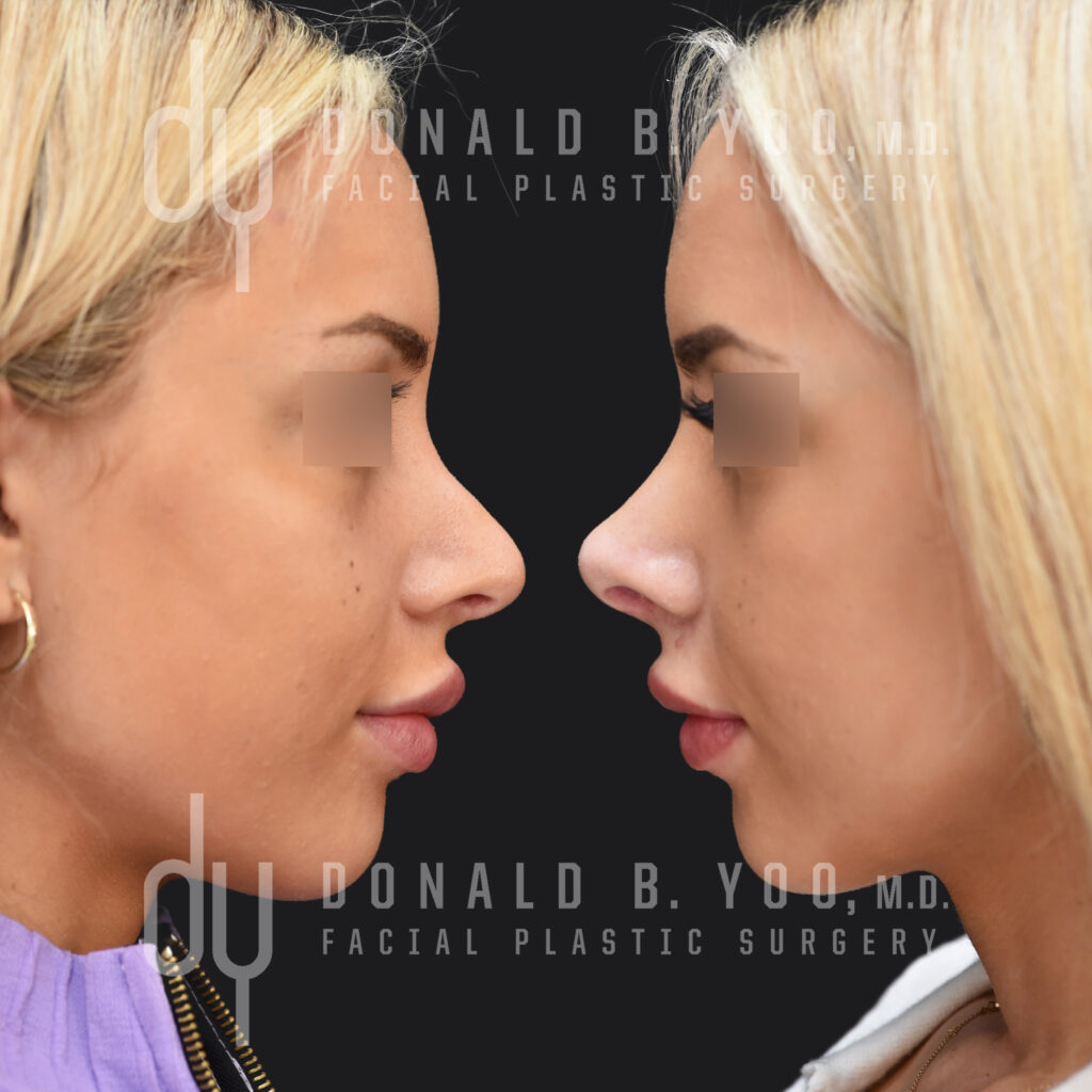 Revision rhinoplasty with rib cartilage to create greater tip refinement and to eliminate a pollybeak deformity.