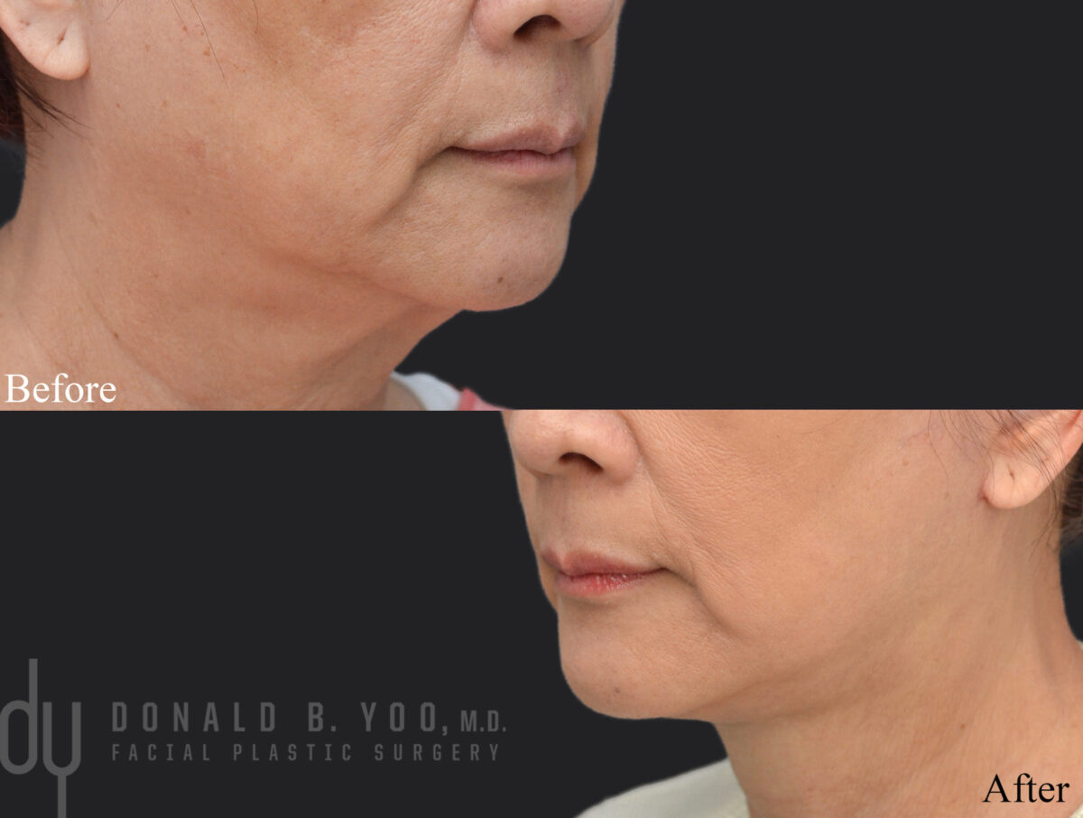 SURGICAL :: FACELIFT<br>Deep Plane Facelift