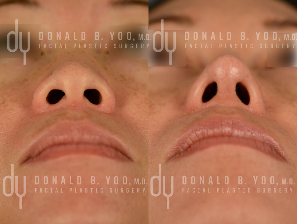 Alarplasty Nostril Reduction Before and After