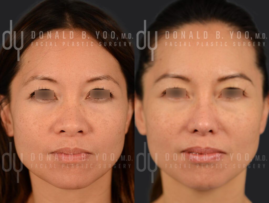 Alarplasty Before and After 
Asian Rhinoplasty Specialist 