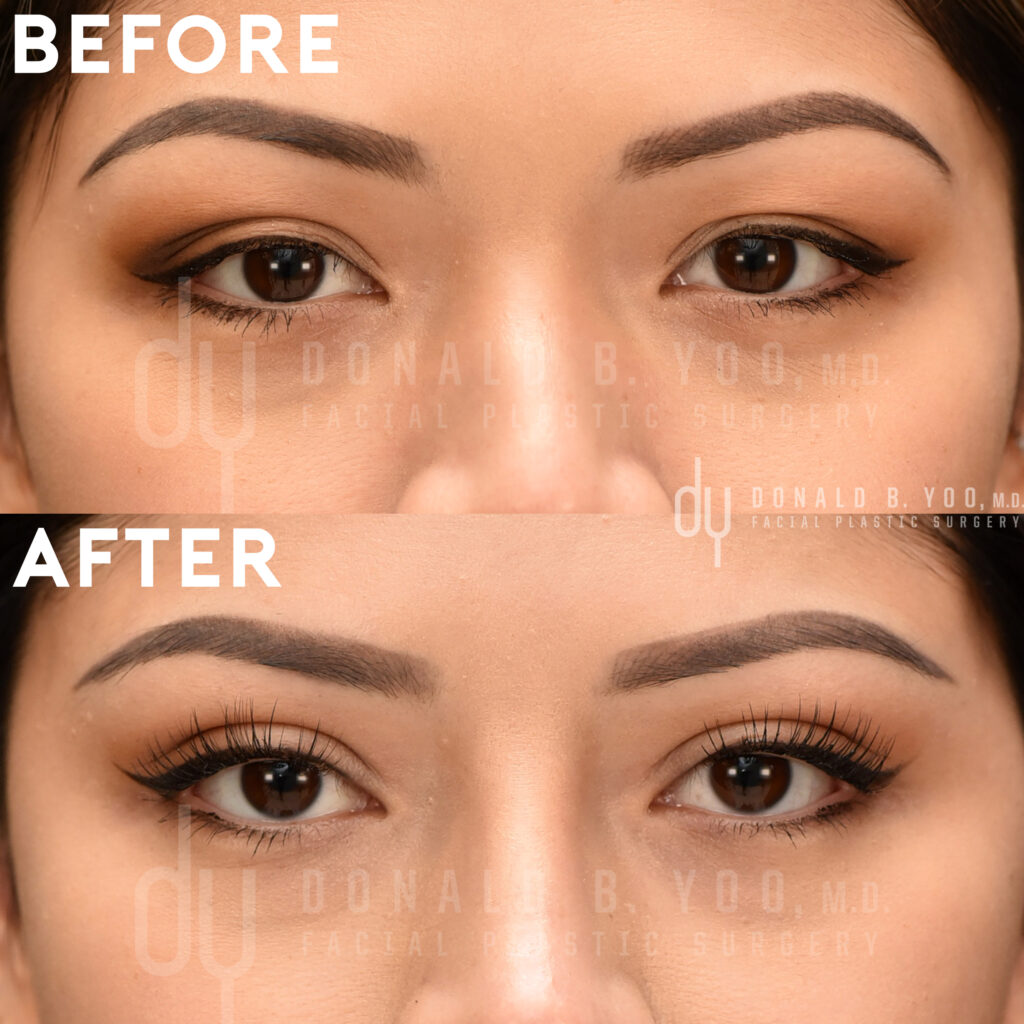 Before and after Asian Blepharoplasty with supratarsal fixation 
double eyelid surgery