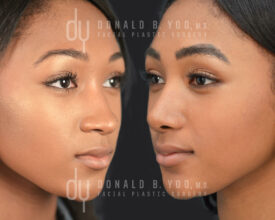 SURGICAL :: RHINOPLASTY<br>African American Rhinoplasty with Rib Cartilage and DCF