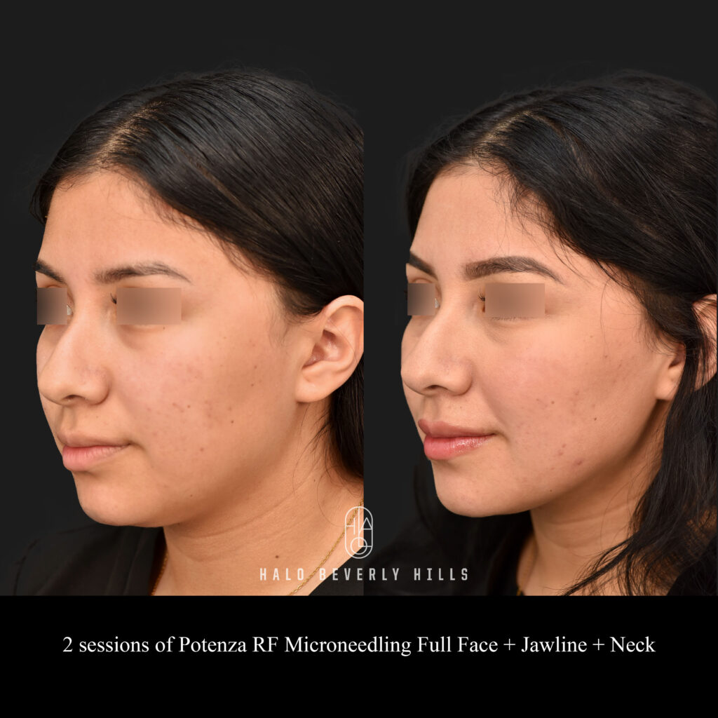 Nonsurgical Neck Lift with Potenza