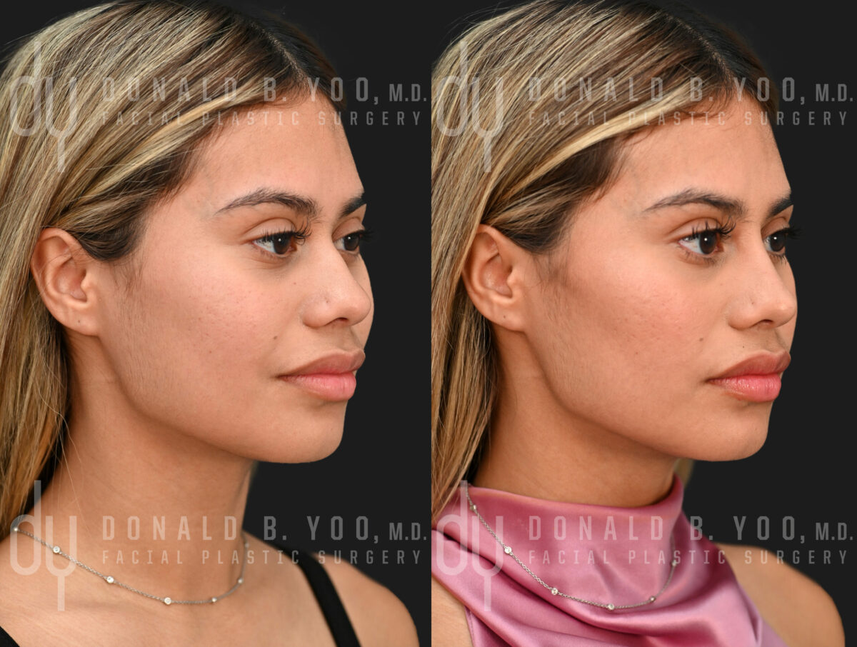 NONSURGICAL :: FILLERS<br>Nonsurgical Rhinoplasty