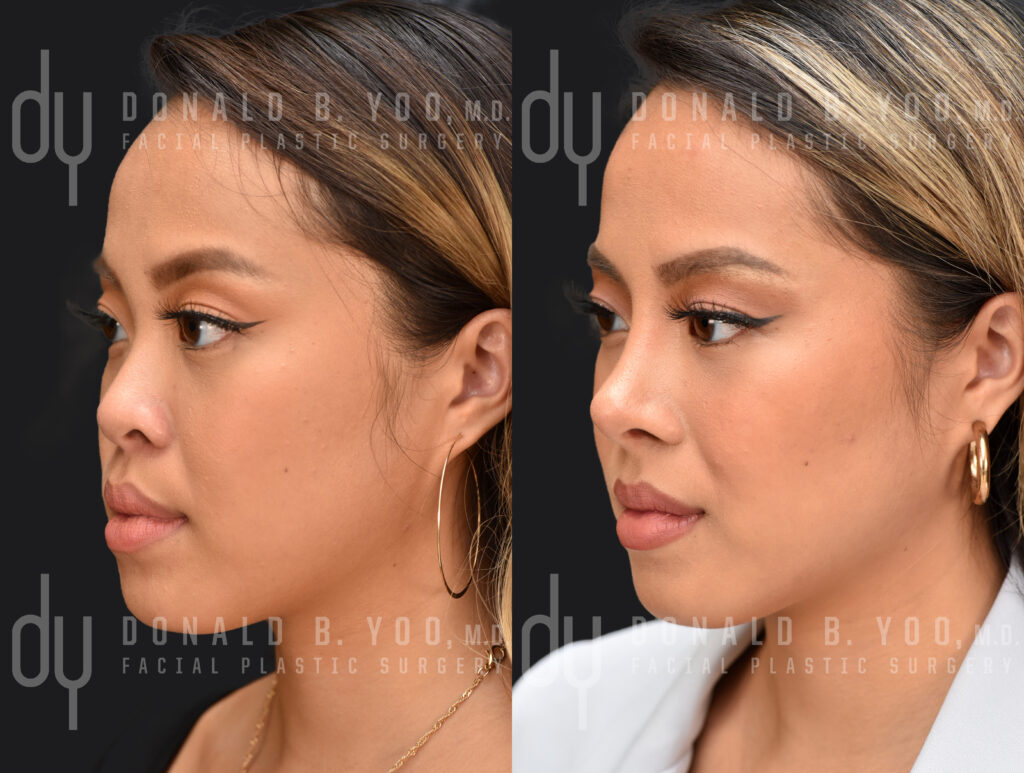 Before and After Asian rhinoplasty (Asian Nose Job) with Asian rhinoplasty specialist, Dr. Donald B. Yoo, M.D.
