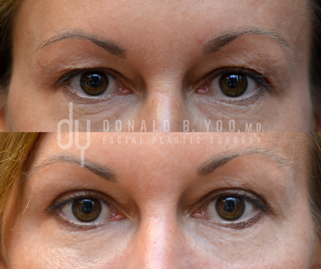 Before and after upper blepharoplasty (upper eyelid surgery)