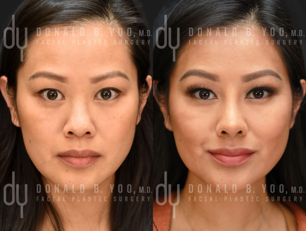 Asian Rhinoplasty with rib cartilage and diced cartilage fascia (DCF) by Dr. Donald B. Yoo