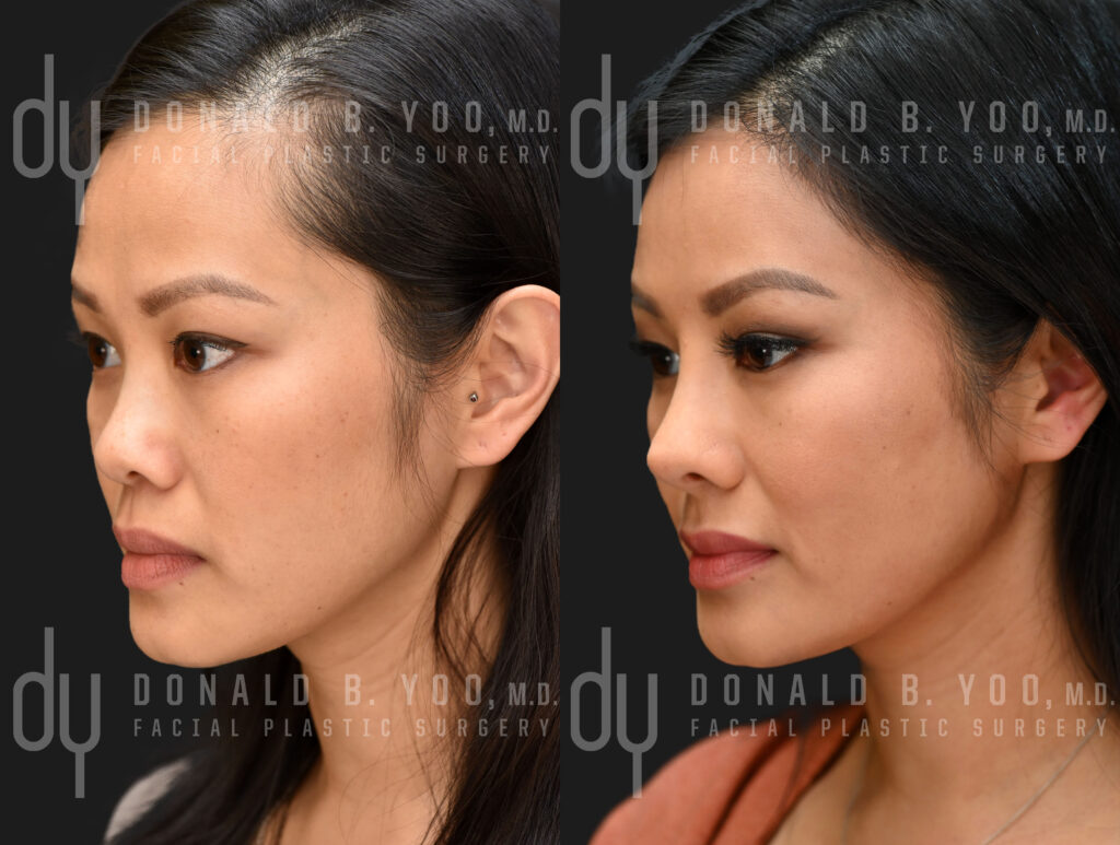 Asian rhinoplasty with rib cartilage and diced cartilage fascia (DCF) with Dr. Donald B. Yoo, M.D.  #YOOnose