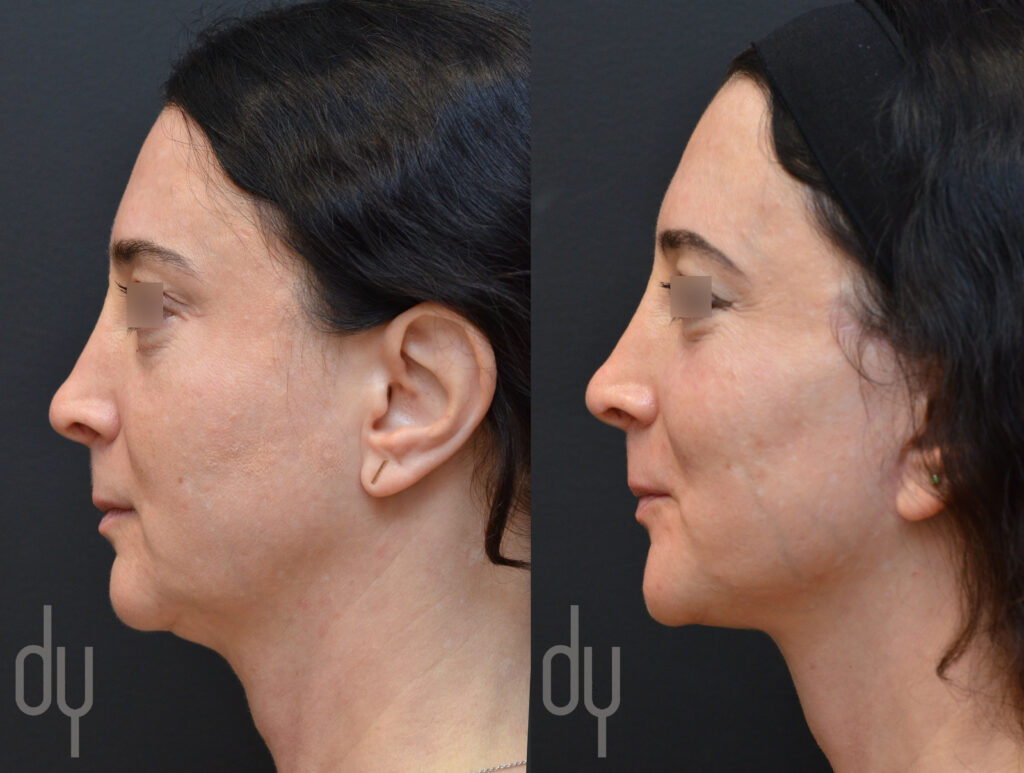 Neck lift and deep-plane facelift before and after 