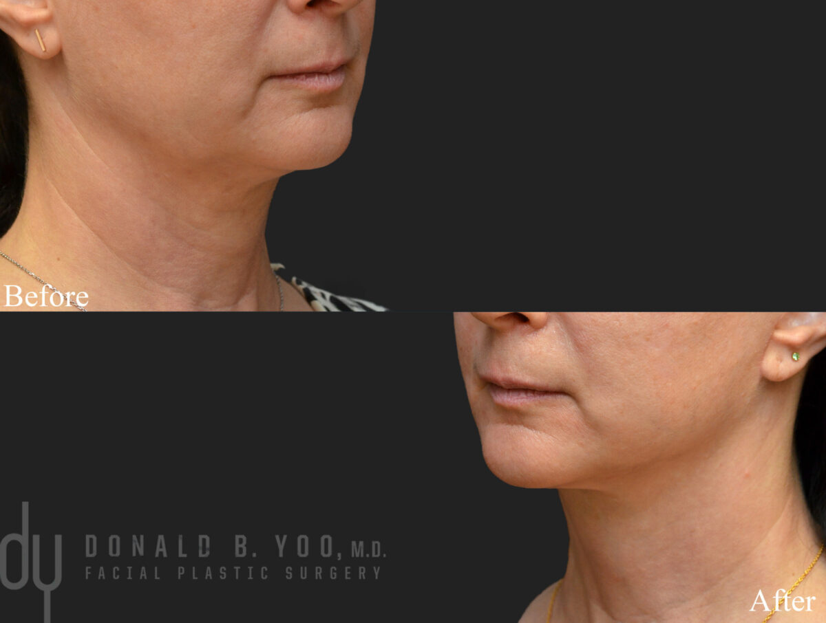 SURGICAL :: FACELIFT<br>Facelift, Necklift