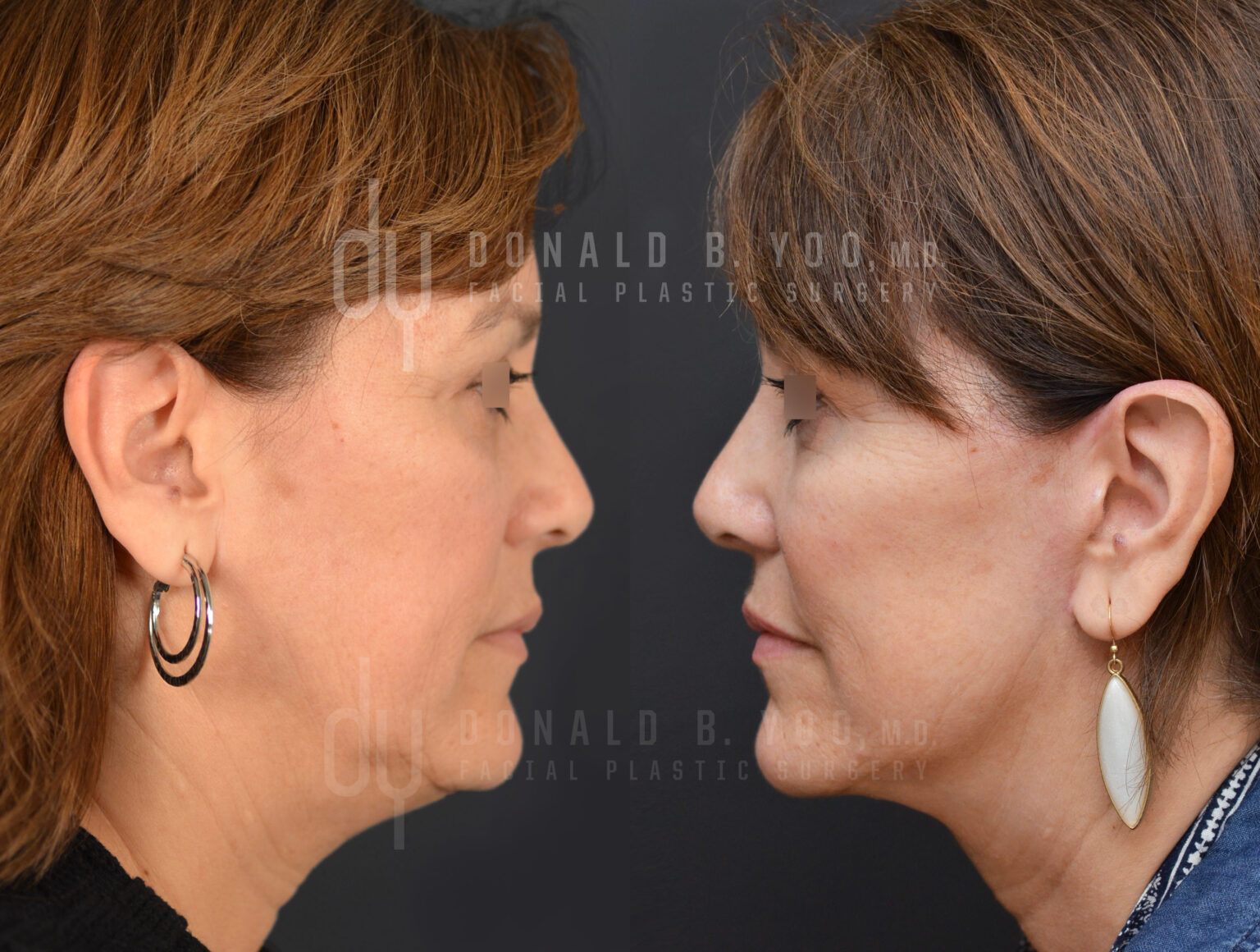What is a facelift? How long does a facelift usually last? Beverly
