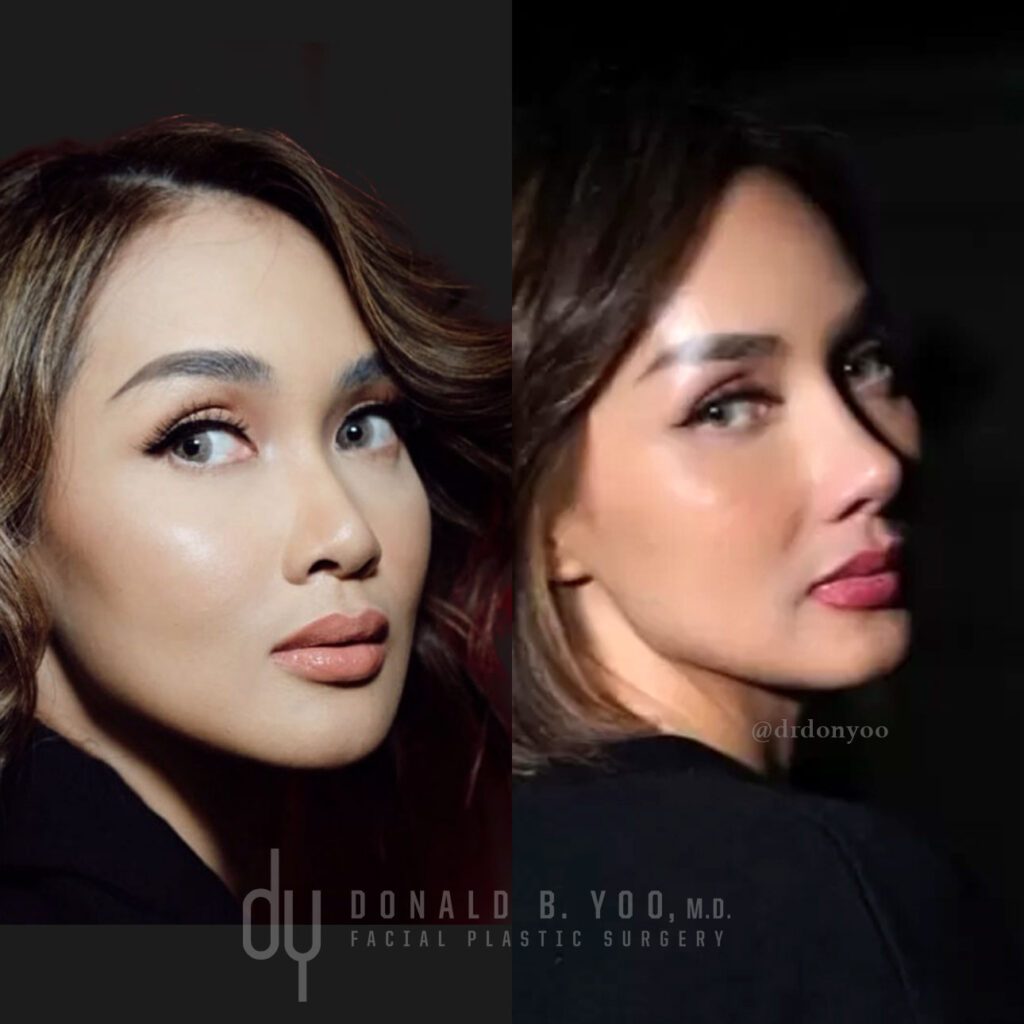 Revision Asian rhinoplasty before and after using rib cartilage and diced cartilage fascia graft for natural dorsal augmentation and tip refinement