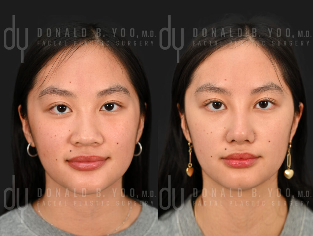 Before and After Asian rhinoplasty with unified rib cartilage grafts and diced cartilage fascia (DCF). 