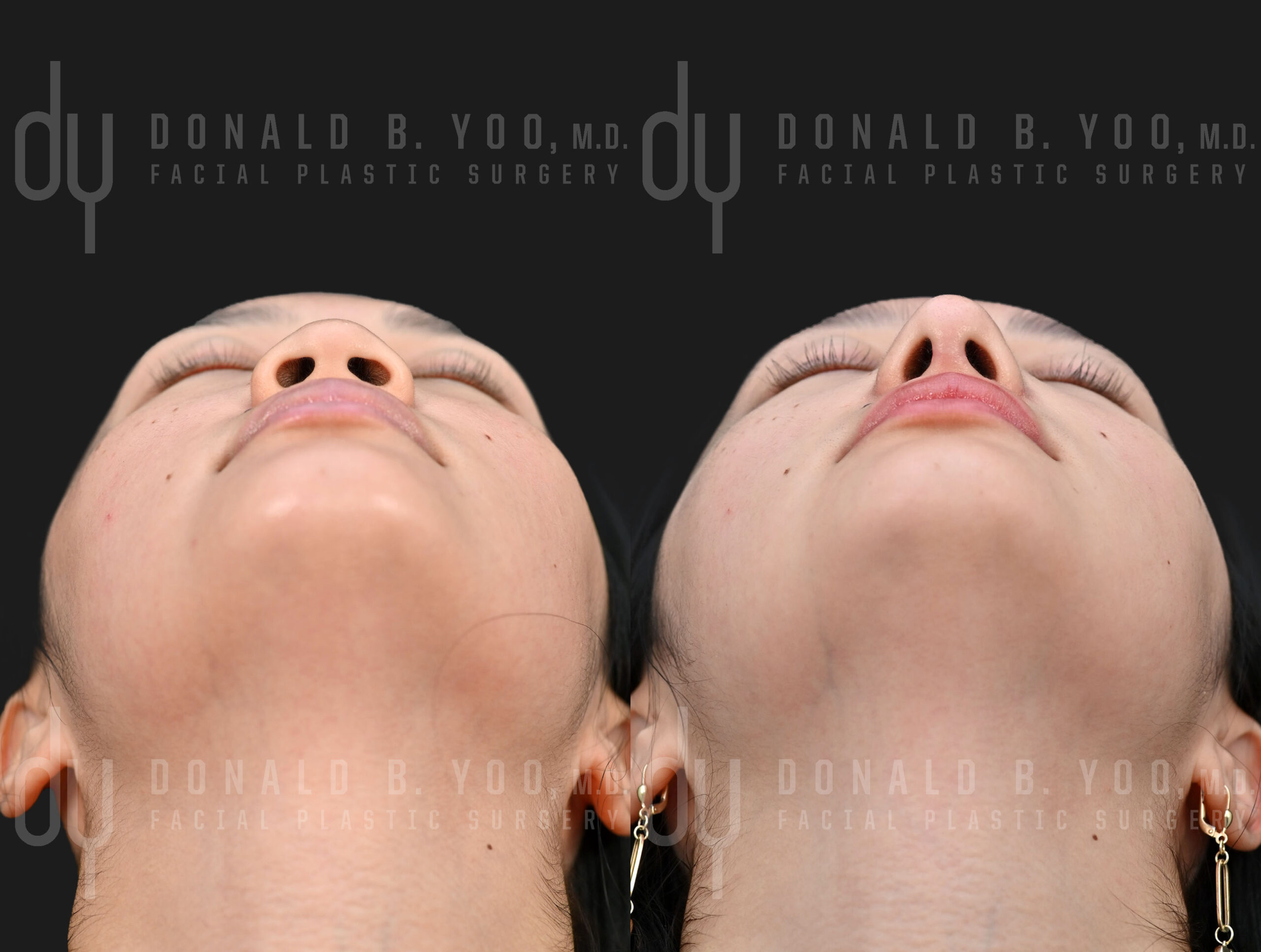 SURGICAL :: RHINOPLASTY<br>Alar Base Modification