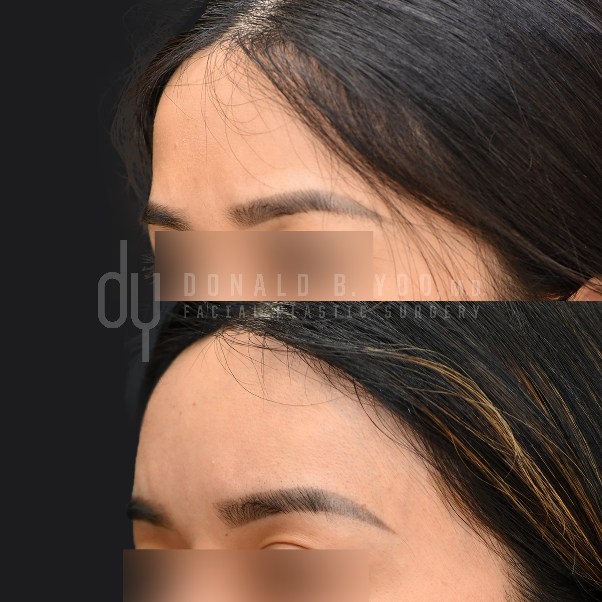 SURGICAL :: FAT GRAFTING<br>Fat Grafting to Forehead