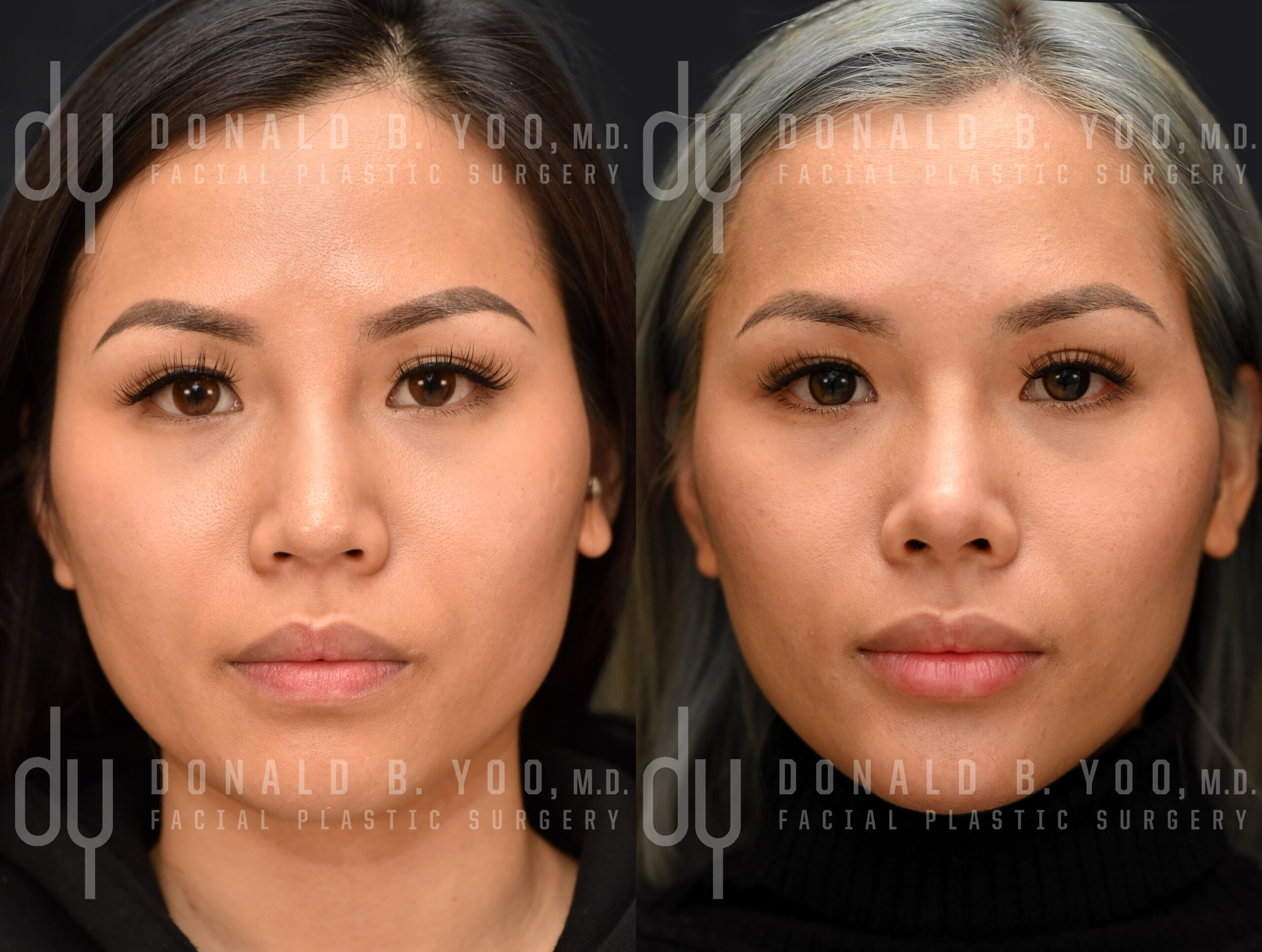 SURGICAL :: RHINOPLASTY<br>Asian Rhinoplasty with Rib Cartilage and DCF