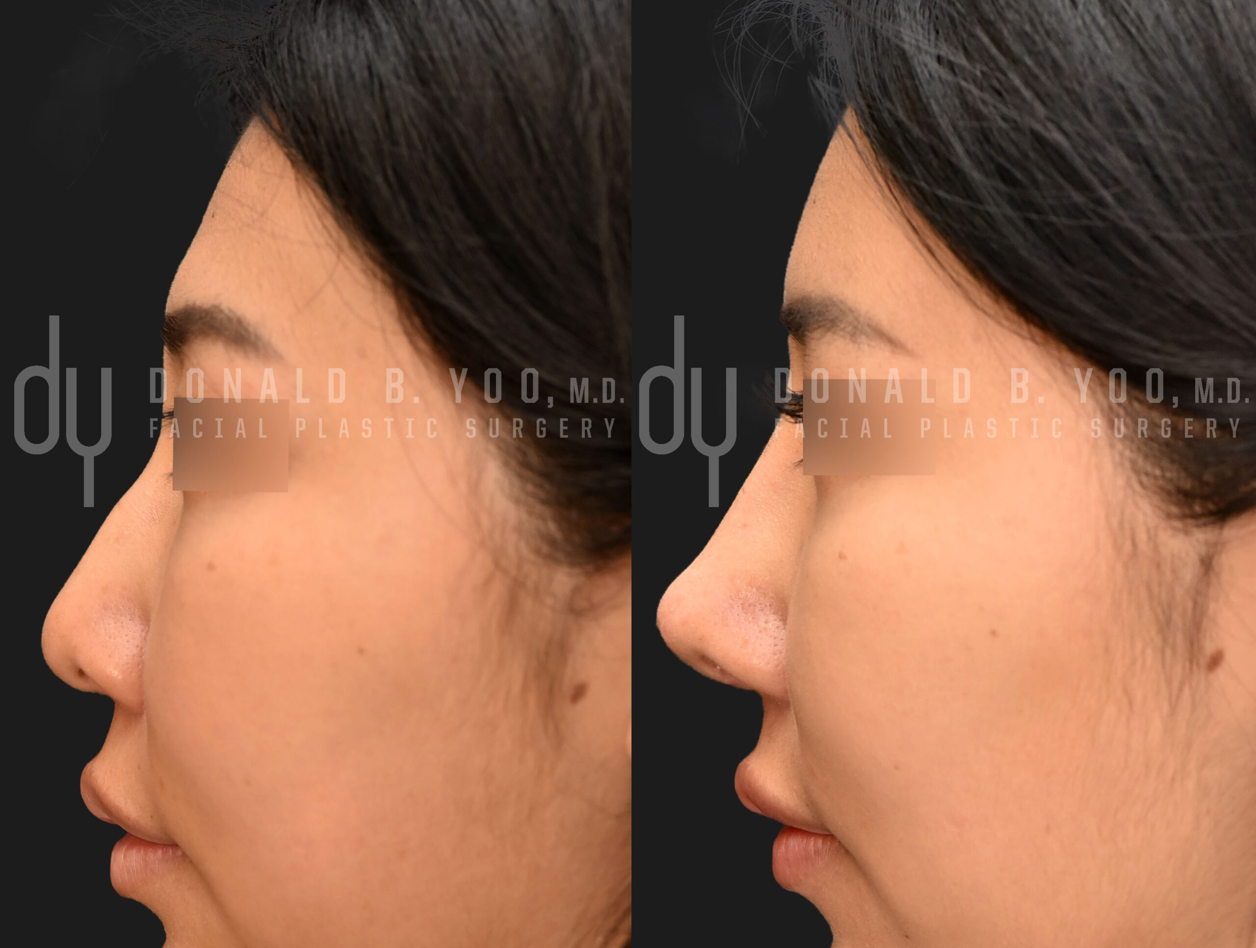 SURGICAL :: FAT GRAFTING<br>Fat Grafting to Forehead