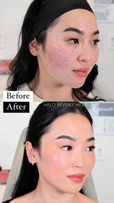 Before and after Rejuran Healer (Polynucleotide) skin boosting injections.