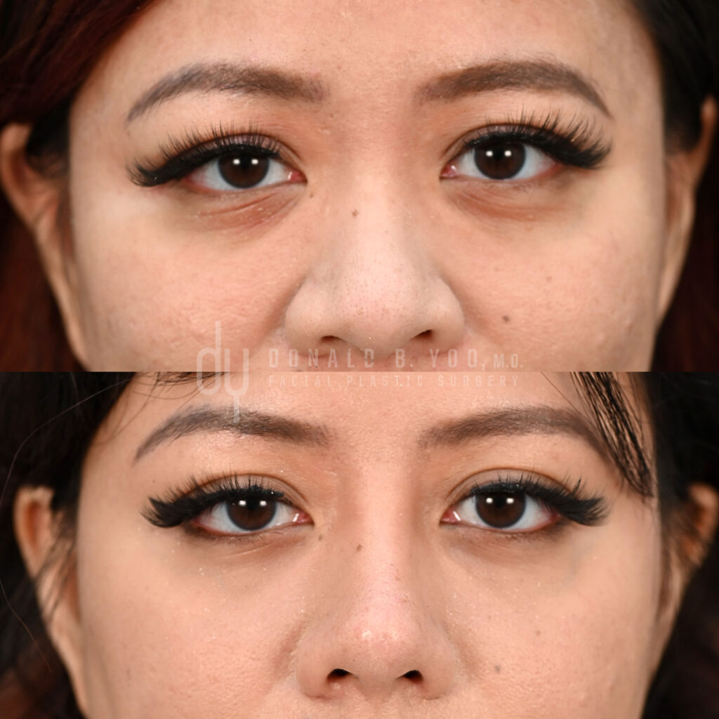Before and after temporal browlift