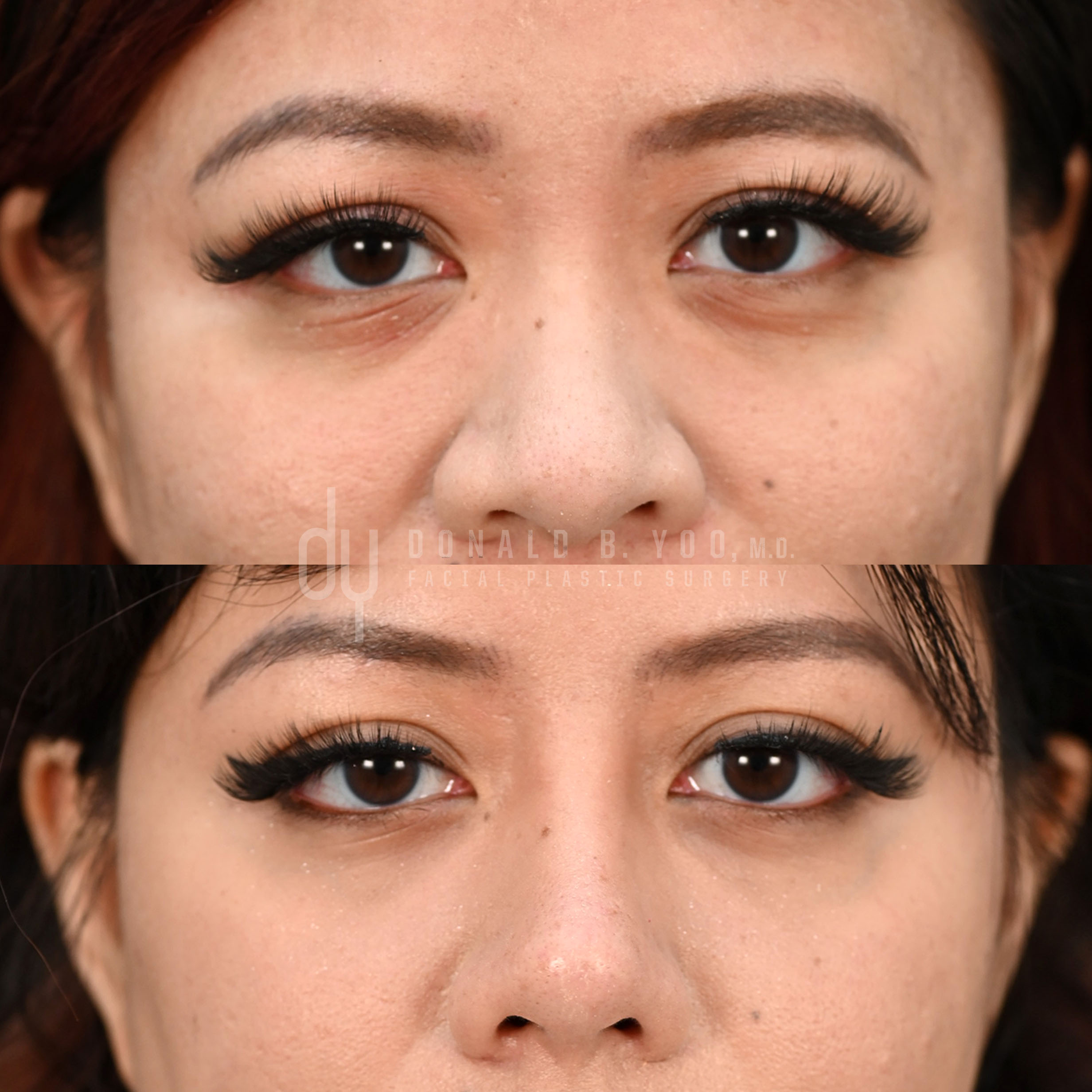 SURGICAL :: BROWLIFT<br>Endoscopic Browlift
