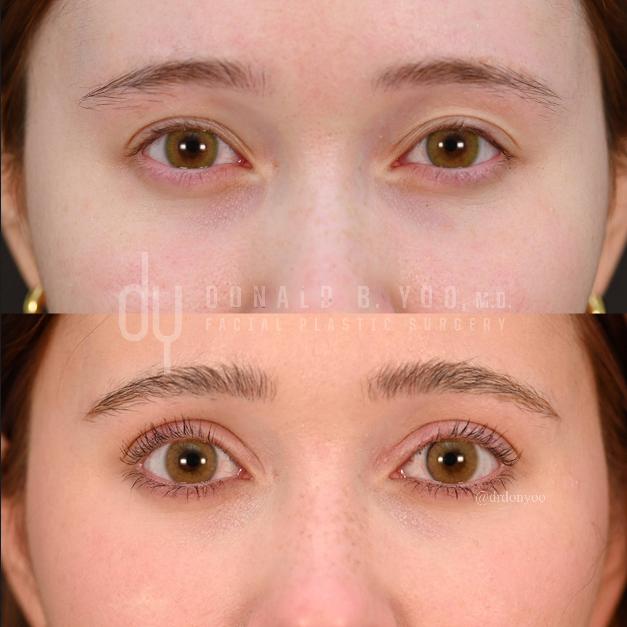 SURGICAL :: BLEPHAROPLASTY<br>Upper Blepharoplasty