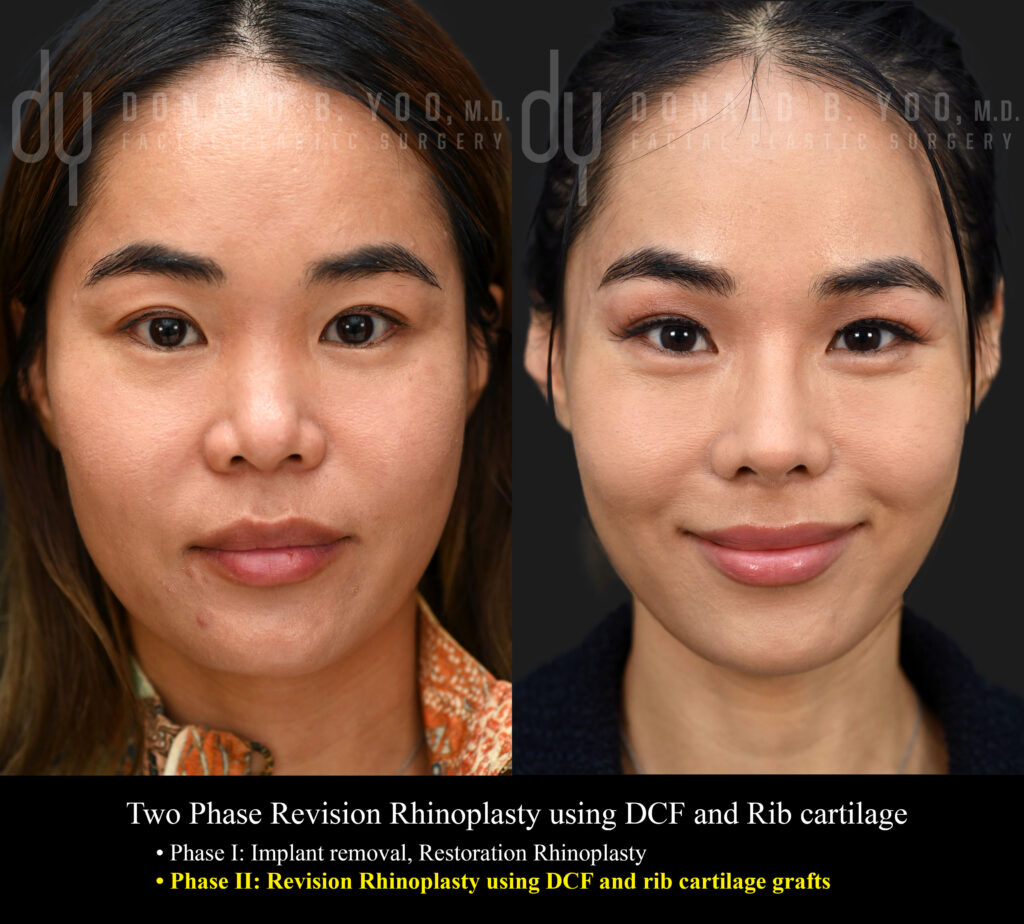 Before and after revision Asian rhinoplasty