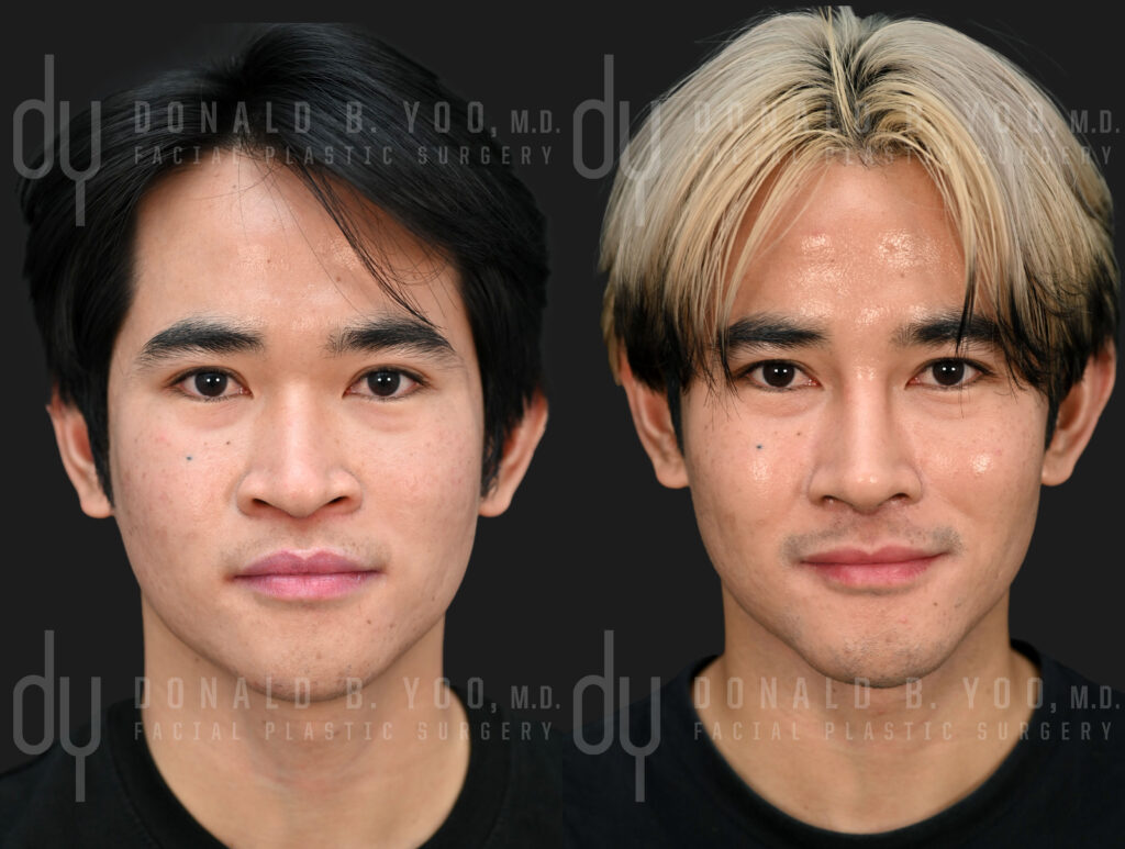 Before and After Male Asian rhinoplasty